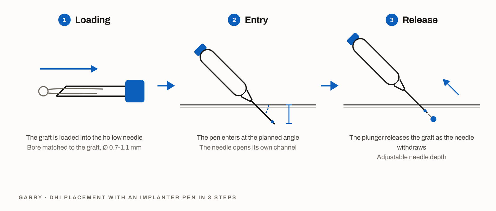 DHI placement in 3 steps, the graft loaded into the hollow needle, the pen entering at the planned angle and the plunger releasing the graft as the needle withdraws