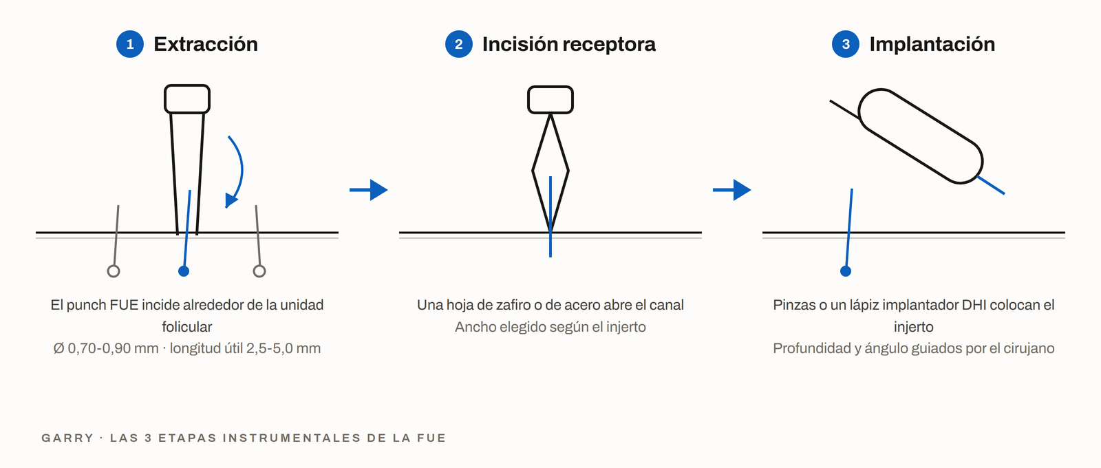 Las 3 etapas del instrumental FUE - extracción con punch, incisión con hoja y colocación con implantador