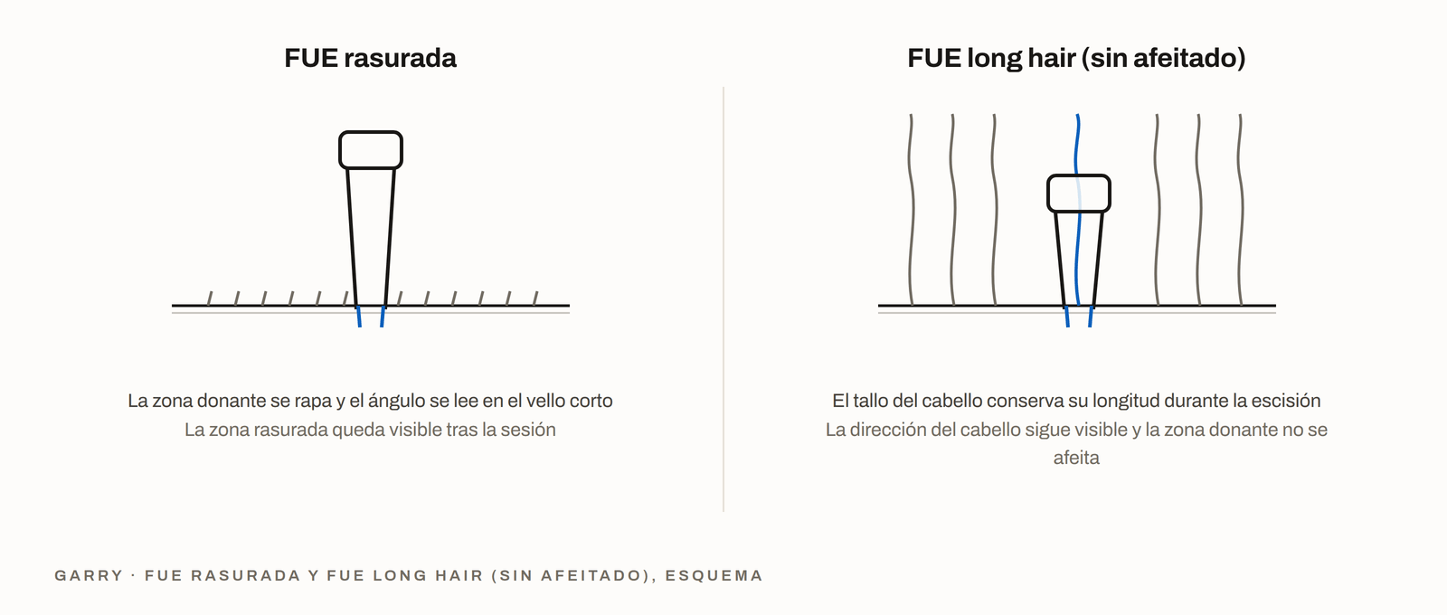 FUE con rasurado frente a FUE long hair sin afeitado - zona donante rasurada frente a tallo del pelo intacto con dirección visible