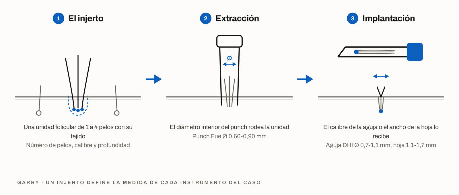 Esquema en 3 pasos, la unidad folicular en la zona donante, el diámetro interior del punch elegido para ella y el calibre de la aguja o el ancho de la hoja que la recibe