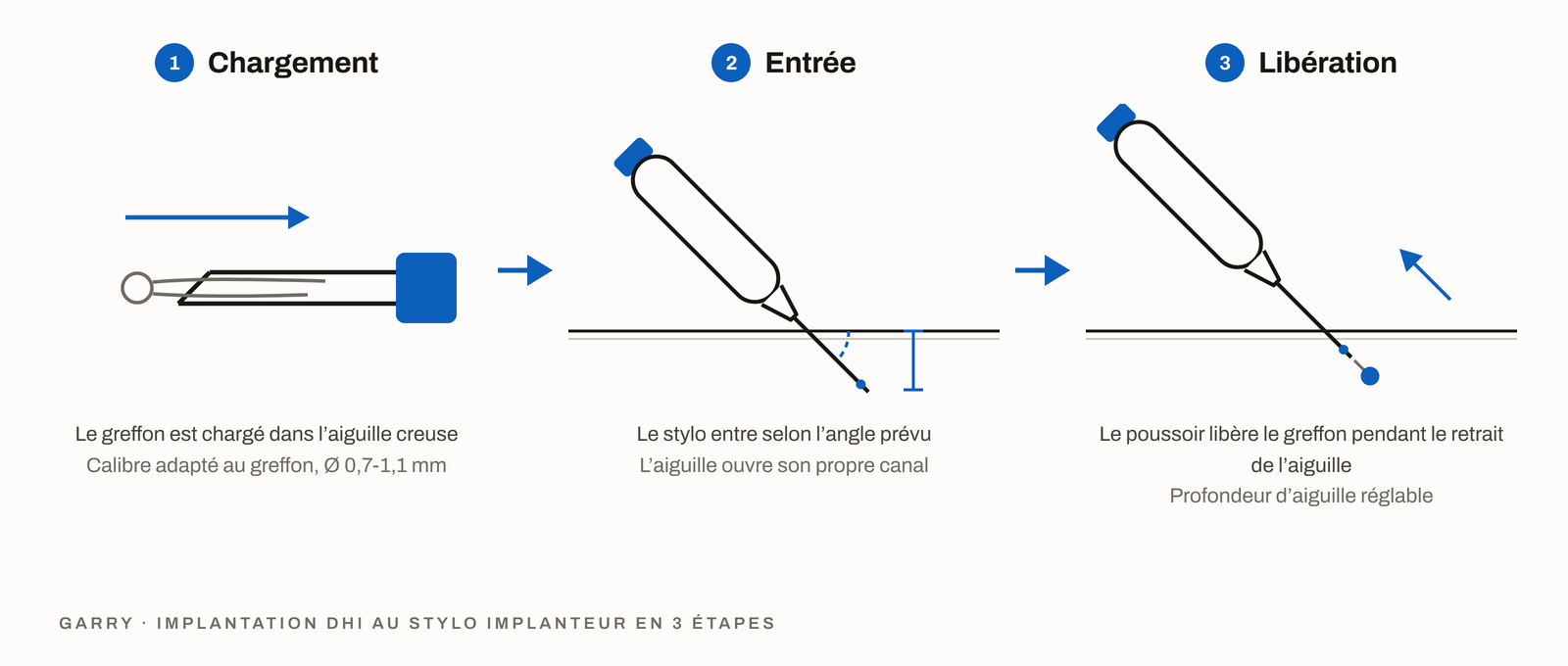L’implantation DHI en 3 étapes, le greffon chargé dans l’aiguille creuse, le stylo qui entre selon l’angle prévu et le poussoir qui libère le greffon pendant le retrait de l’aiguille
