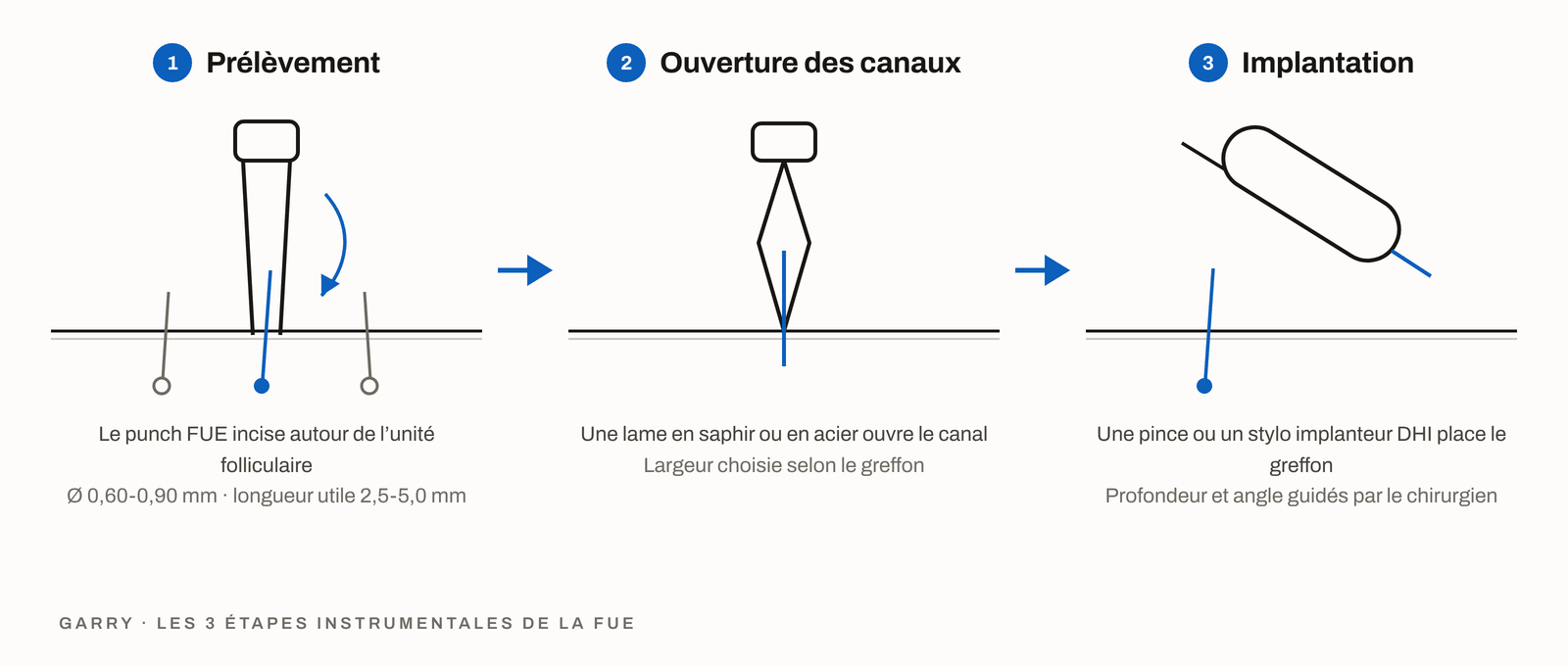 Les 3 étapes instrumentales de la FUE - prélèvement au punch, incision à la lame et implantation à l’implanteur