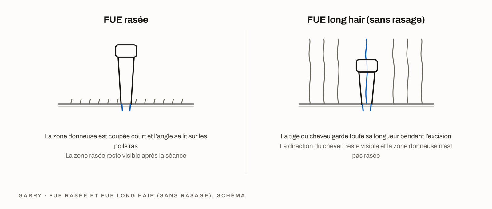 FUE avec rasage et FUE long hair sans rasage - zone donneuse tondue et tige du cheveu intacte avec sa direction visible