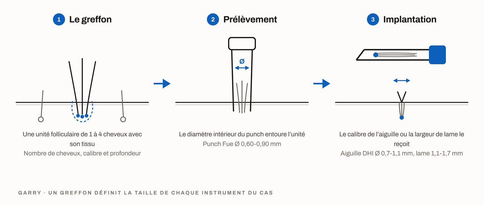Schéma en 3 étapes, l’unité folliculaire dans la zone donneuse, le diamètre intérieur du punch choisi pour elle et le calibre de l’aiguille ou la largeur de lame qui la reçoit
