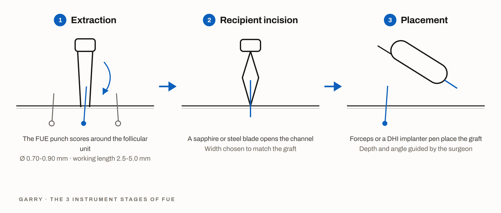 The three instrument stages of FUE - punch extraction, blade incision and implanter placement