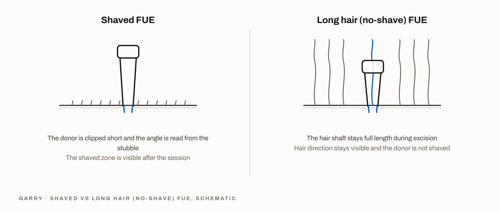 Shaved FUE versus long-hair no-shave FUE - clipped donor versus intact hair shaft with visible direction