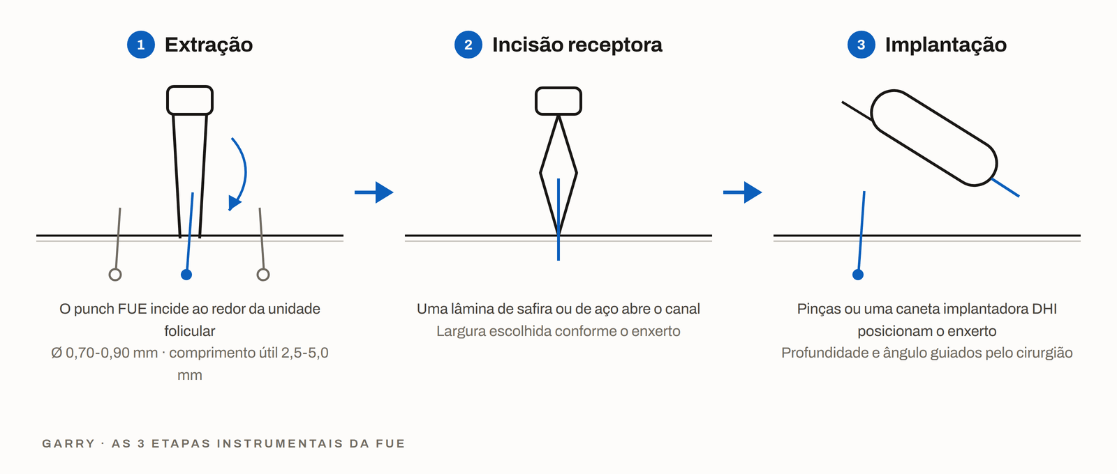 As 3 etapas do instrumental da FUE - extração com punch, incisão com lâmina e implantação com implantador