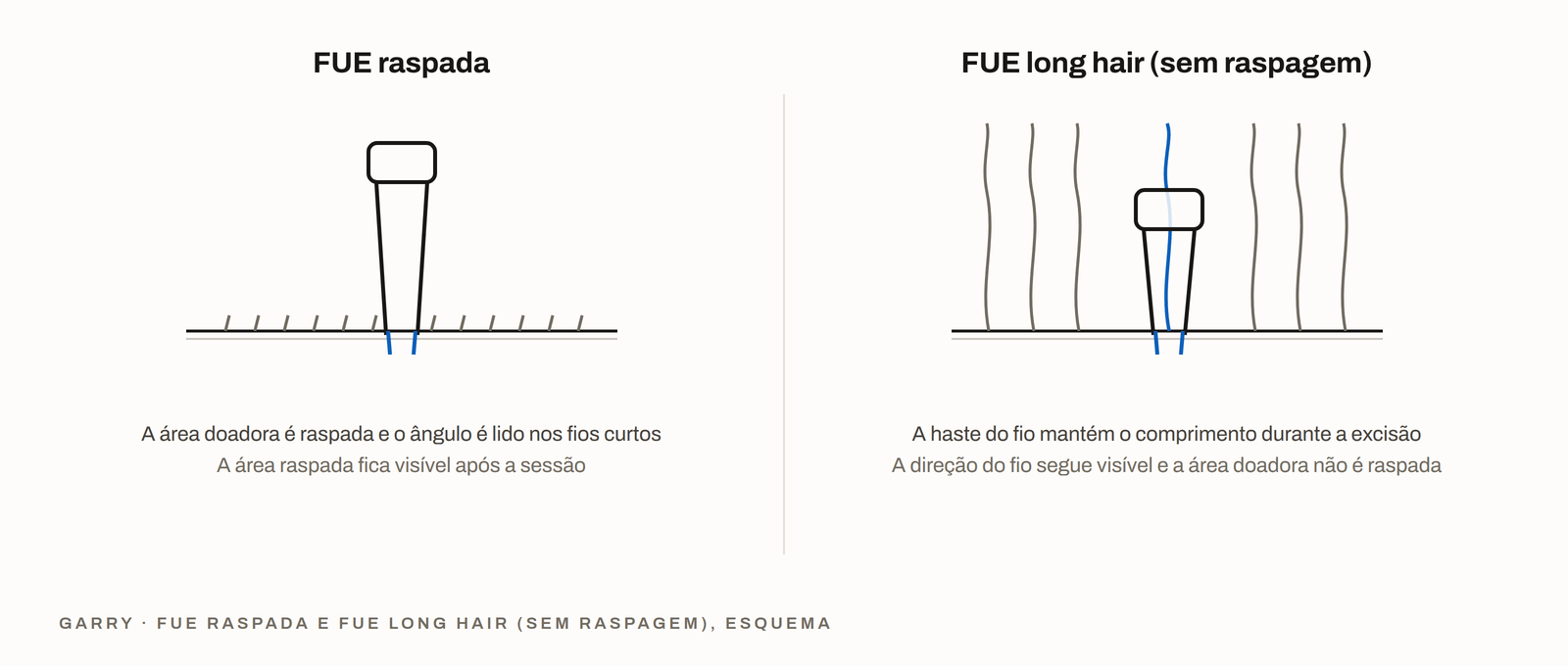 FUE com raspagem versus FUE long hair sem raspagem - área doadora aparada versus haste do fio intacta com a direção visível