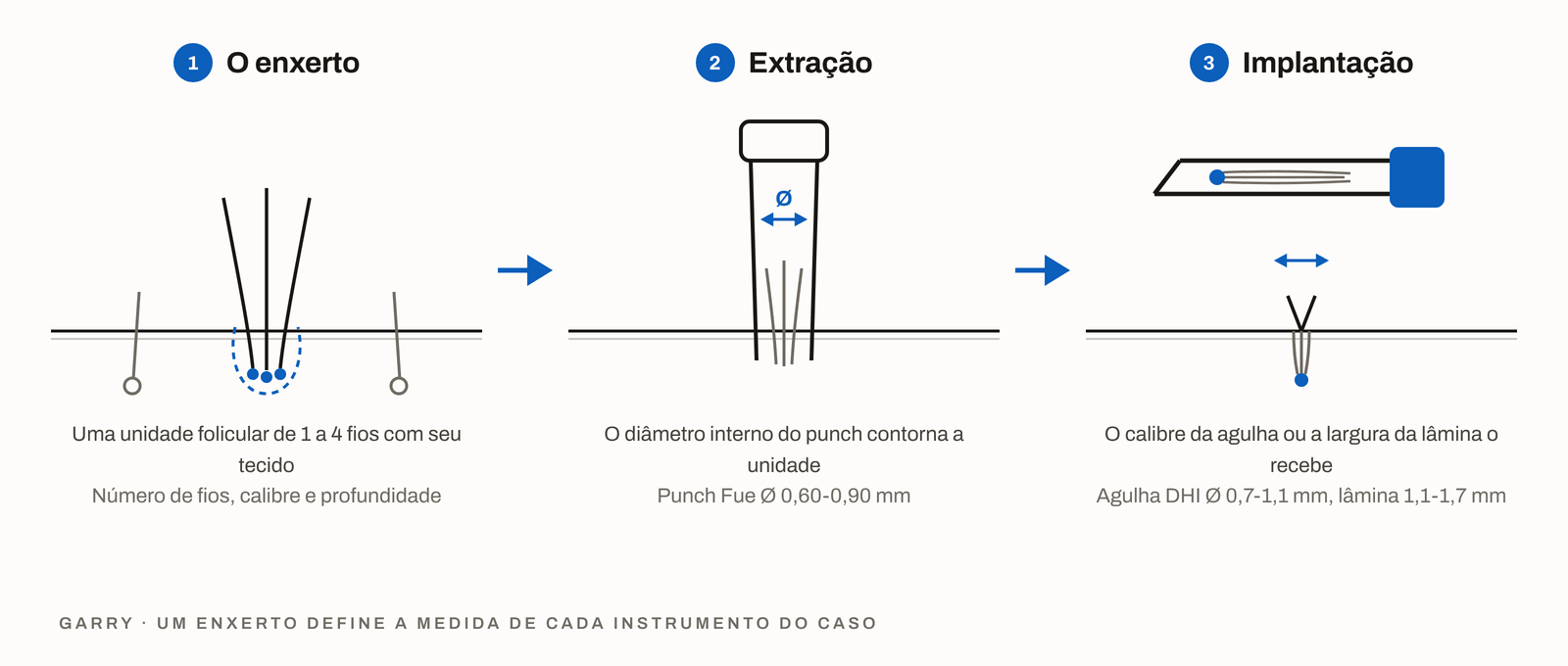 Esquema em 3 etapas, a unidade folicular na área doadora, o diâmetro interno do punch escolhido para ela e o calibre da agulha ou a largura da lâmina que a recebe