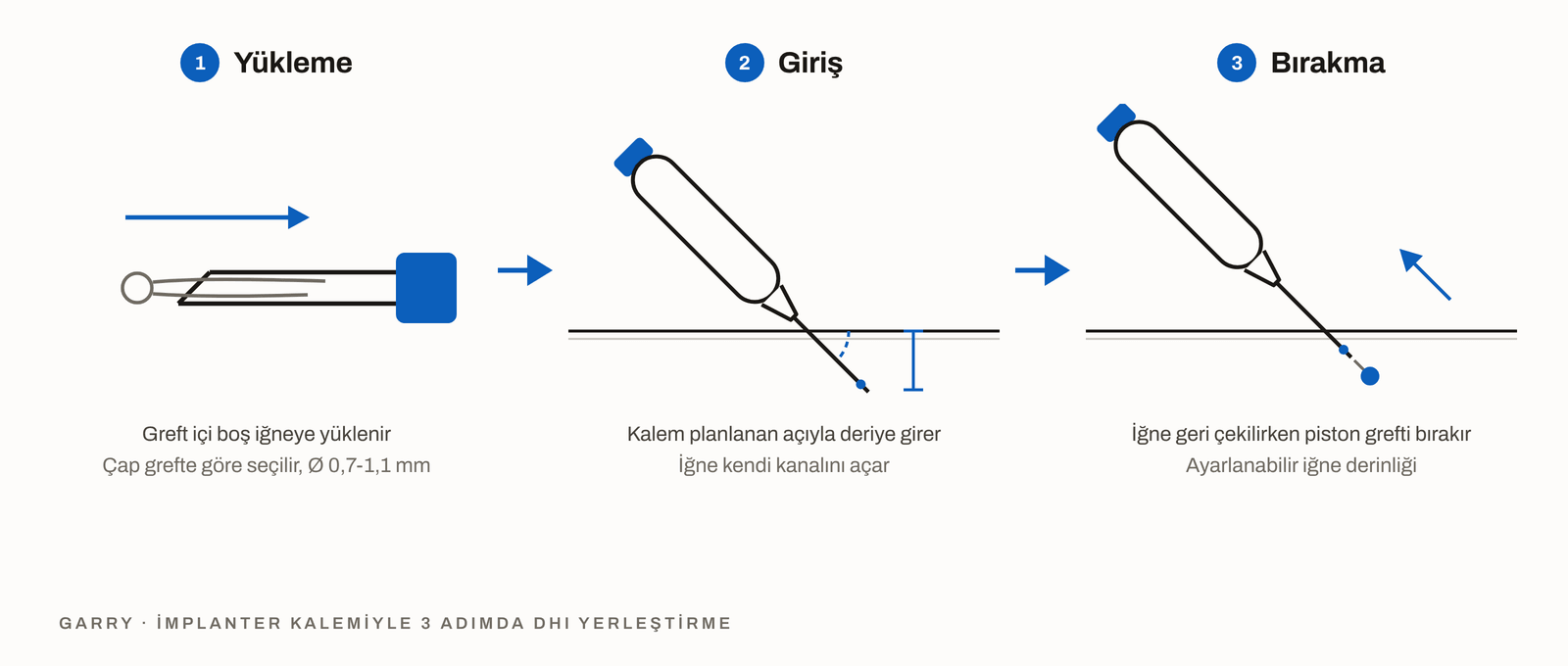 3 adımda DHI yerleştirme, içi boş iğneye yüklenen greft, planlanan açıyla giren kalem ve iğne geri çekilirken grefti bırakan piston