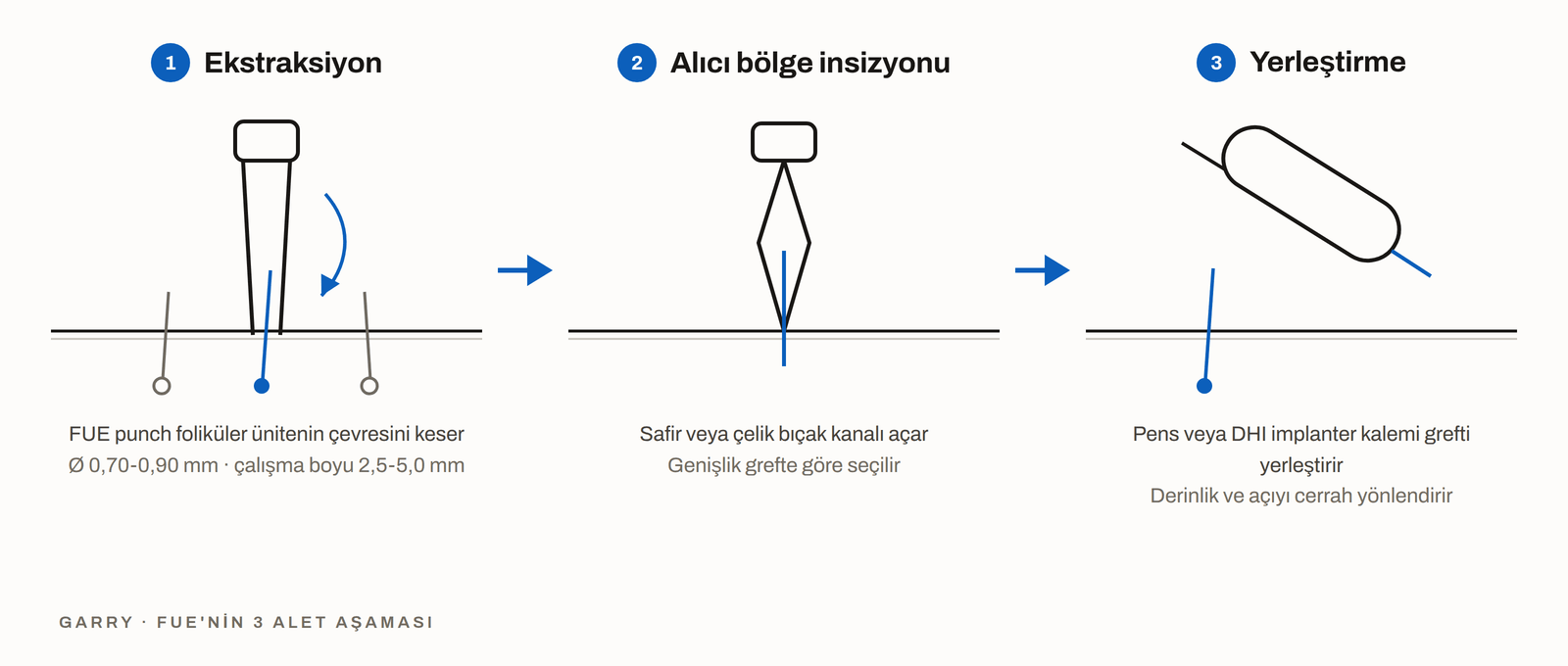 FUE'nin 3 enstrüman aşaması - punch ile ekstraksiyon, bıçakla insizyon ve implanter ile yerleştirme