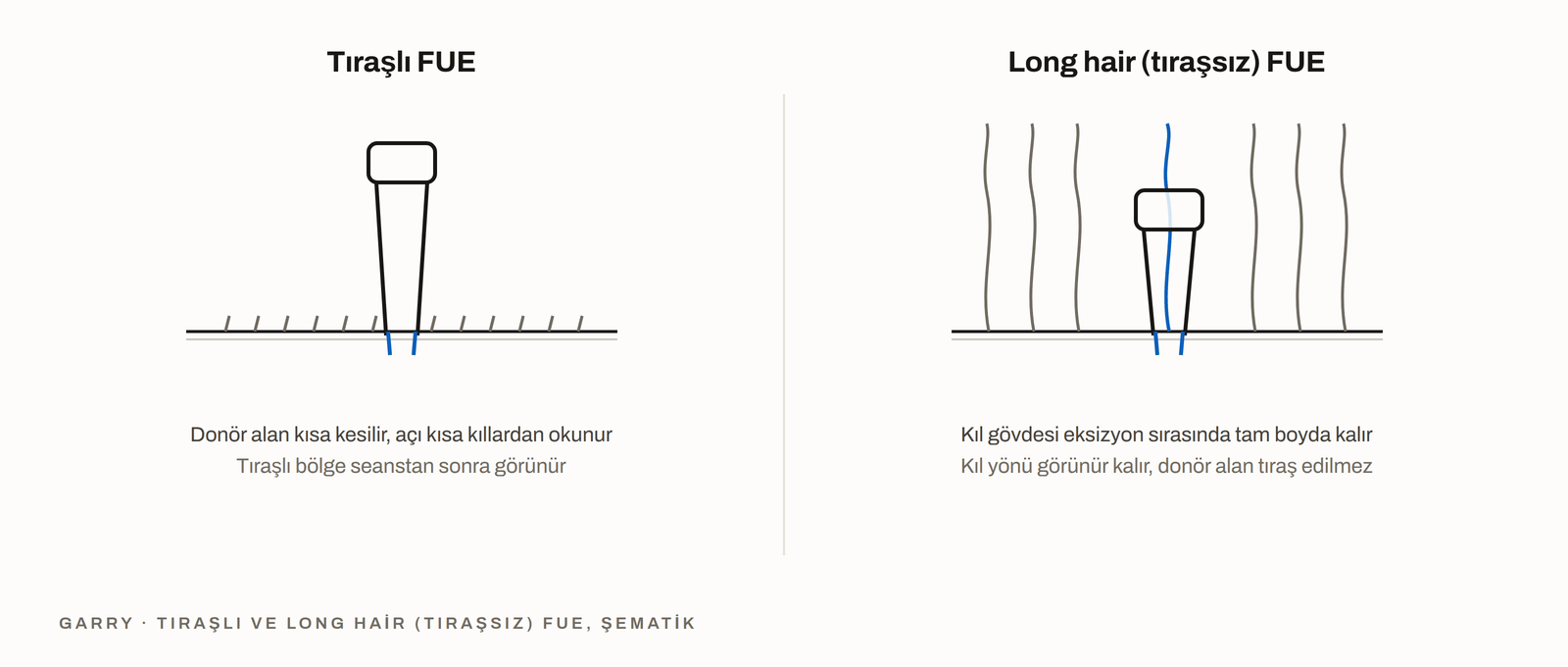 Tıraşlı FUE ve long hair tıraşsız FUE - kısa kesilmiş donör alan ile yönü görülebilen, bozulmamış kıl gövdesi