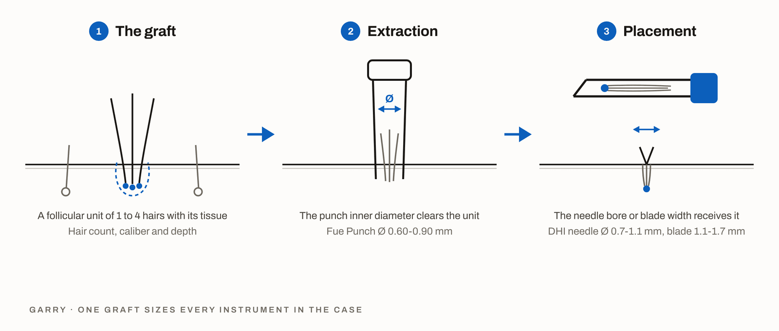 Diagram in 3 steps, the follicular unit in the donor area, the punch inner diameter sized to it and the needle bore or blade width that receives it